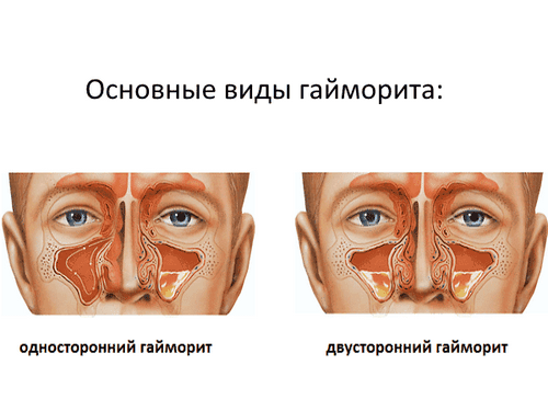 як лікувати верхньощелепної синусит