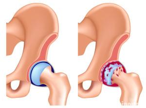 як вилікувати артроз тазостегнового суглоба