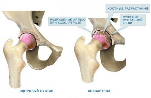 як вилікувати коксартроз кульшового суглоба