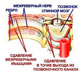 як лікувати міжреберної невралгії