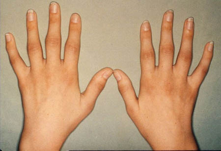 як лікувати ревматоїдний артрит пальців рук народними засобами в домашніх умовах симптоми бабуся відгуки