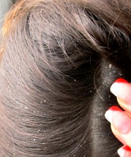себорея шкіри голови симптоми і лікування