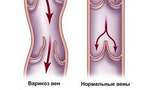 як лікувати варикоз ніг