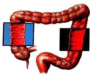 хвороби кишечника