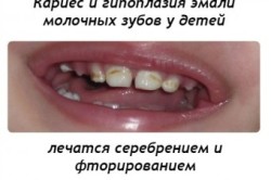 лікувати чи карієс молочних зубів