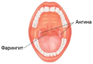 як лікувати фарингіт і ангіну