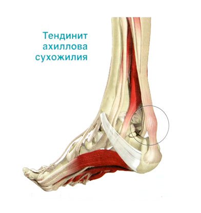 як лікувати розтягнення ахіллового сухожилля