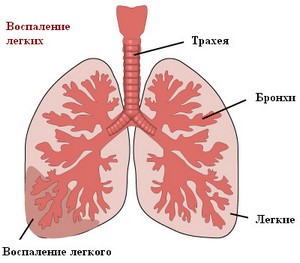 як лікувати пневмонію і бронхіт