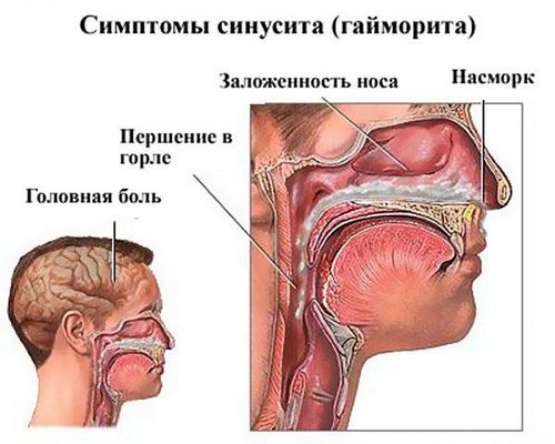 як лікувати легкий гайморит