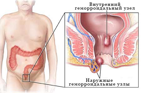 вилікувати геморой за тиждень