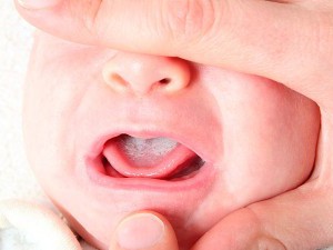 лікувати стоматит новонароджених дітей