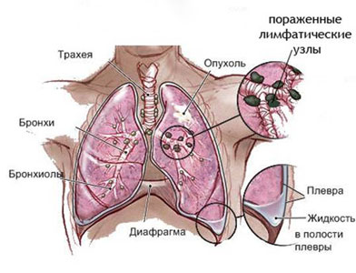 як вилікувати хворі легені