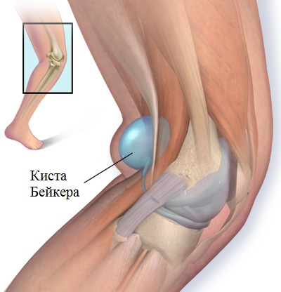 як лікувати кісту Беккера під коліном
