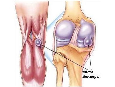 кіста Бейкера лікування народними засобами колінного суглоба як лікувати розрив