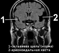 як лікувати кісту головного мозку