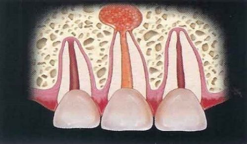 як лікувати кісту кореня зуба
