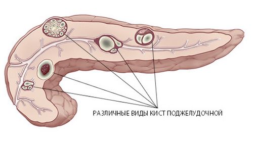 як лікувати кісту підшлункової залози