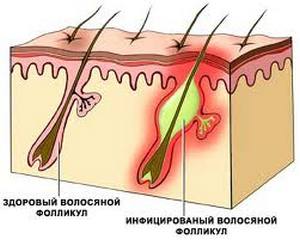 лікувати прищі лазером