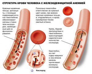 як лікувати анемію без ліків