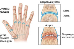 як лікувати артроз кистей рук