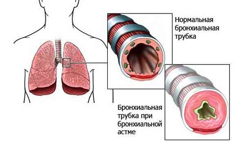 лікувати астму гомеопатією
