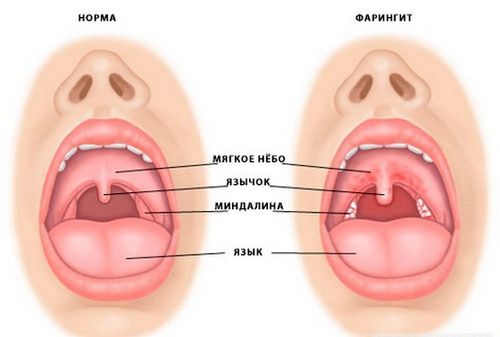 лікувати фарингіт дорослих