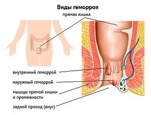 як лікувати легкий геморой