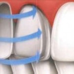 як вилікувати карієс на передніх зубах