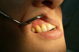 як вилікувати кісту зуба без операції