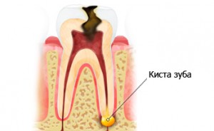 як вилікувати кісту зуба без операції