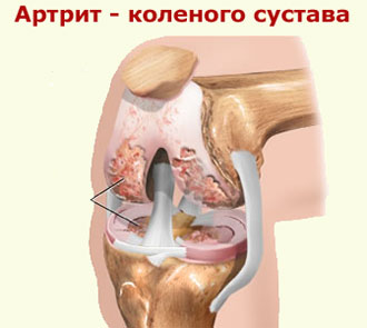 лікувати колінні суглоби народними засобами