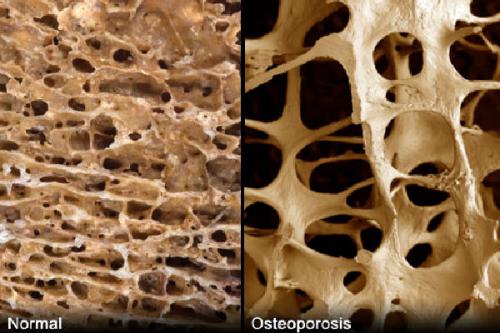 як лікувати остеопороз кісток народними засобами