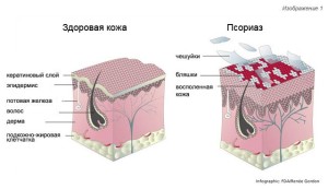 як лікувати псоріаз медикаментами