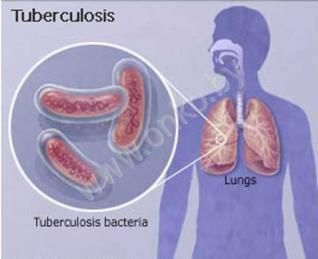 як лікують туберкульоз в лікарні