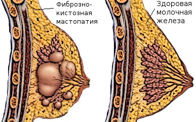 як лікувати мастопатію при грудному вигодовуванні