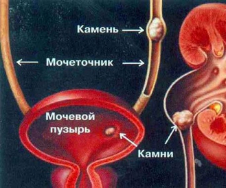 як лікувати сечокислий діатез нирок