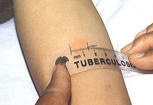 як лікувати латентний туберкульоз