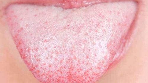 як лікувати обкладений язик