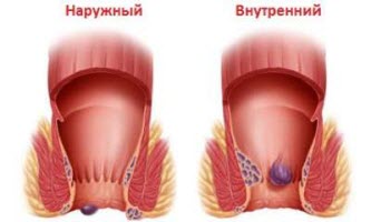 вилікувати зовнішній геморой