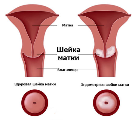 як лікувати генітальний ендометріоз