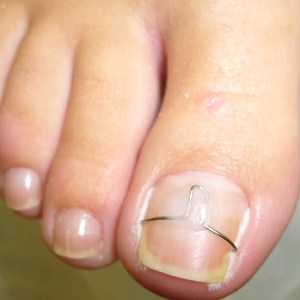 вросли нігті на нозі в пальці гниють