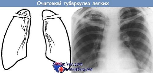 Вогнищевий туберкульоз легень - клініка, діагностика вогнищевий туберкульоз легенів