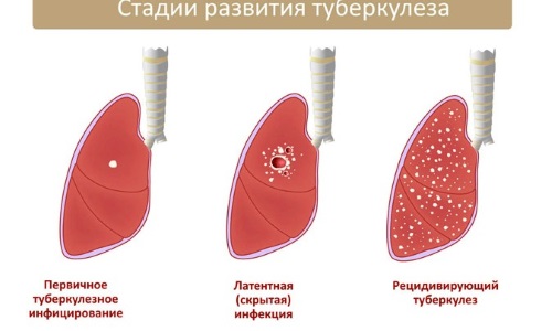 як лікувати вогнищевий туберкульоз легенів