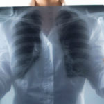 як лікувати вогнищевий туберкульоз легенів