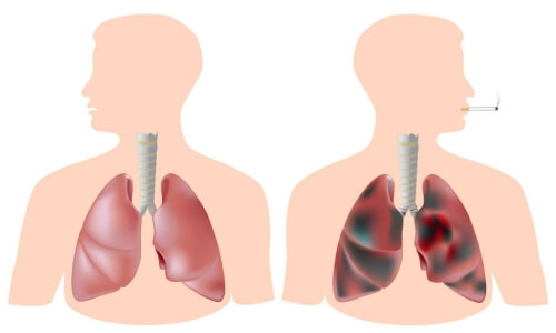 як лікувати легені від куріння