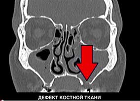 хронічний гайморит диференційний діагноз