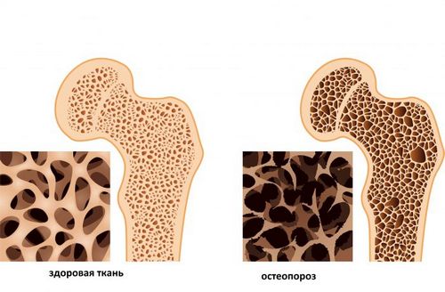 як і чим лікувати остеопороз