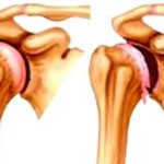 як лікувати остеопороз плечового суглоба