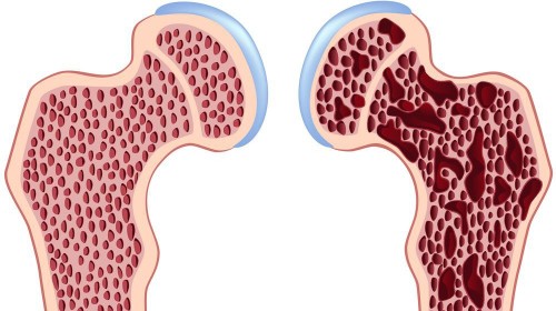 як правильно лікувати остеопороз