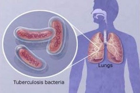 відкритий туберкульоз симптоми